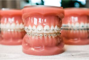 braces