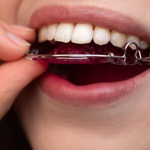 retainers